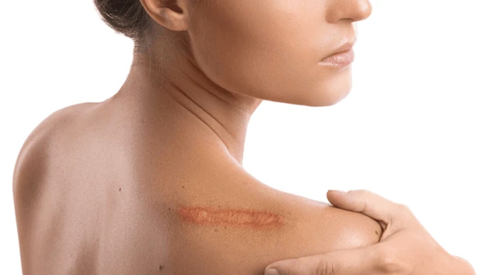 Accidental Scar