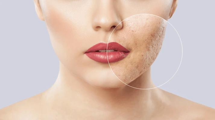 Acne Scar